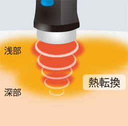 深部の患部も直接温める立体加温