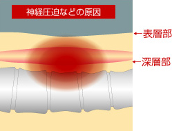 神経圧迫などの原因