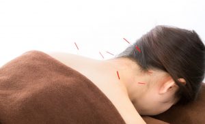 美容鍼とは?
