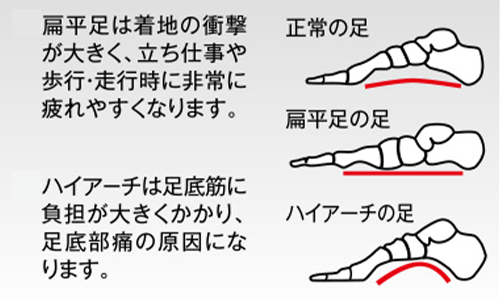 ソルボ足のトラブル説明